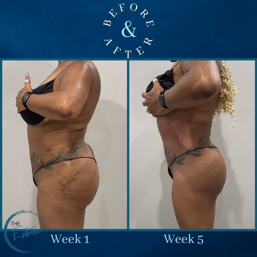 What is the importance of lymphatic drainage after BBL surgery?