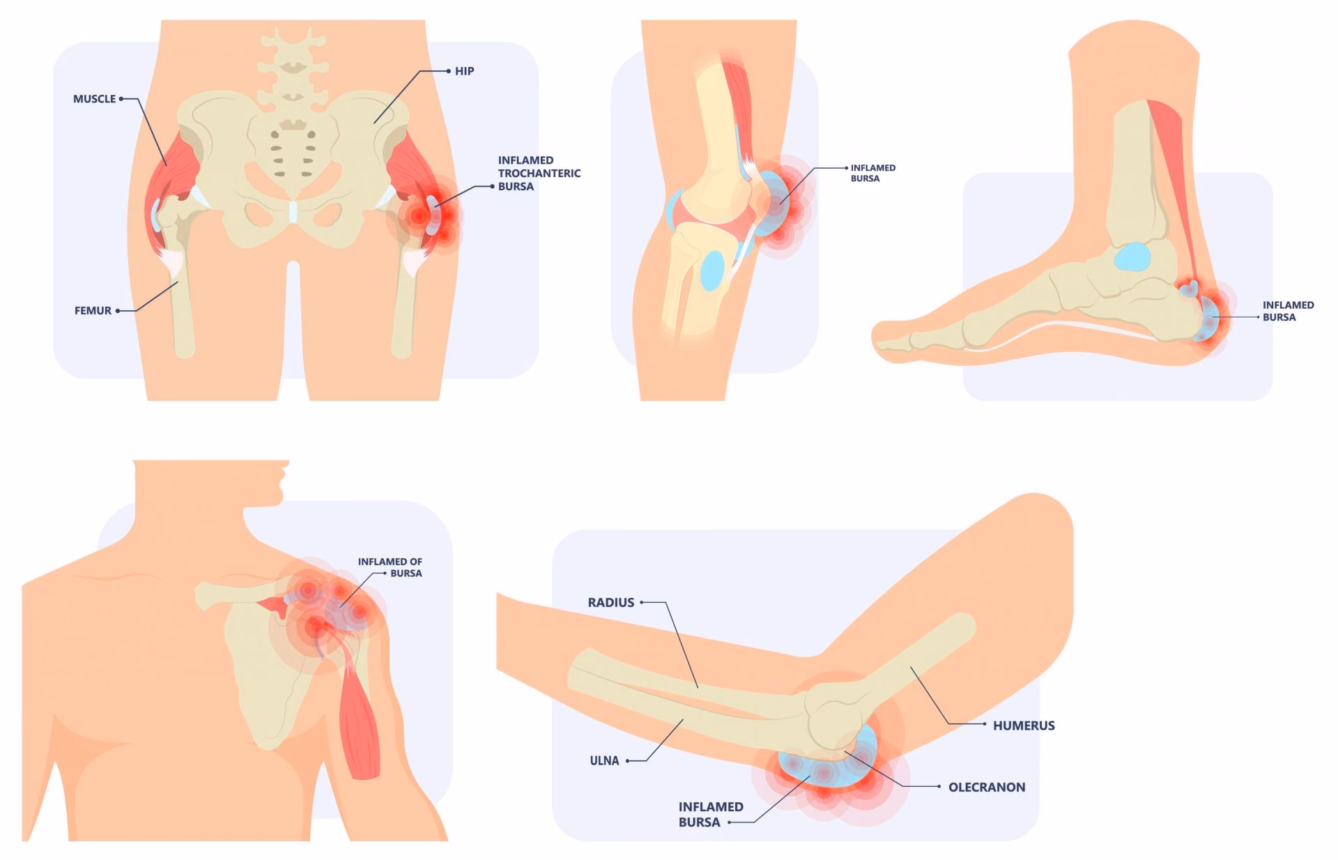 Comment soigner une bursite rapidement ?