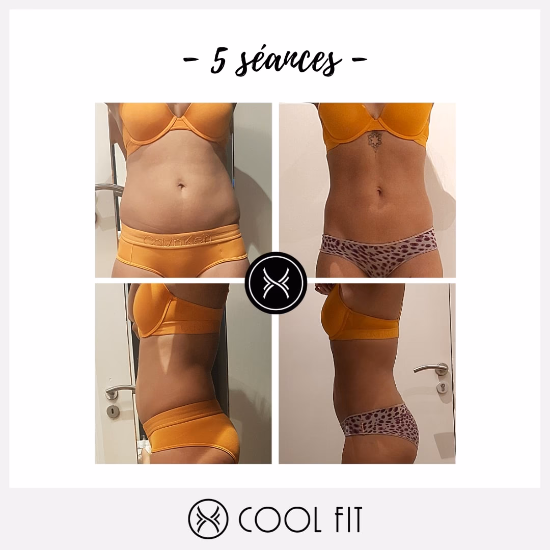 Comment se débarrasser de la cellulite du ventre ?