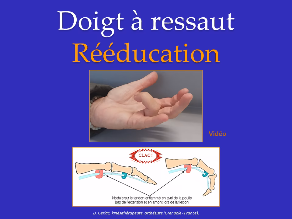 Comment se débarrasser d'un doigt à ressaut ?