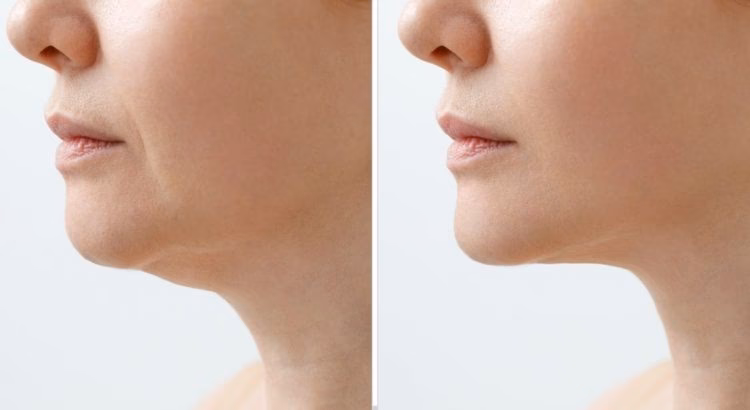 Quelle médecine esthétique pour le double menton ?
