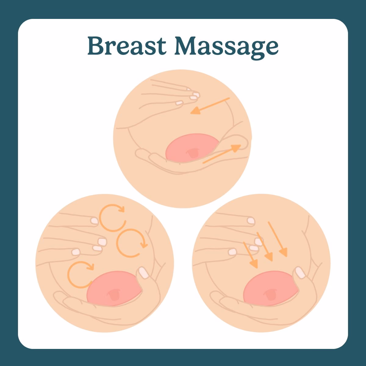 Que faire en cas d’engorgement mammaire ?