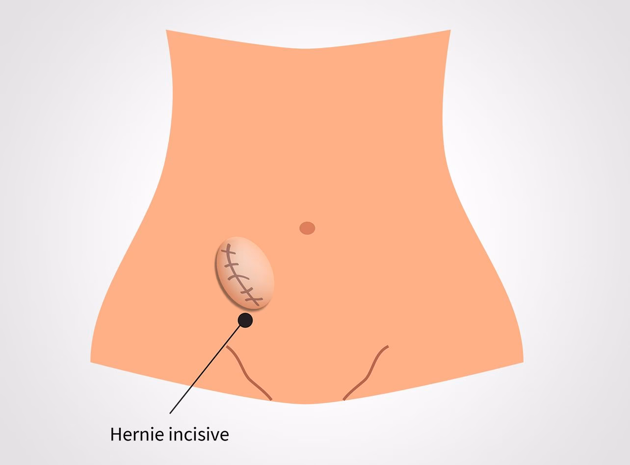 Comment les hernies de la paroi abdominale se manifestent-elles ?