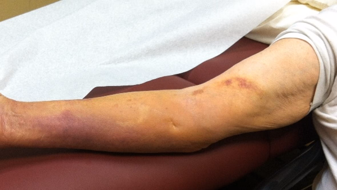 Comment soulager la douleur d’un hématome ?