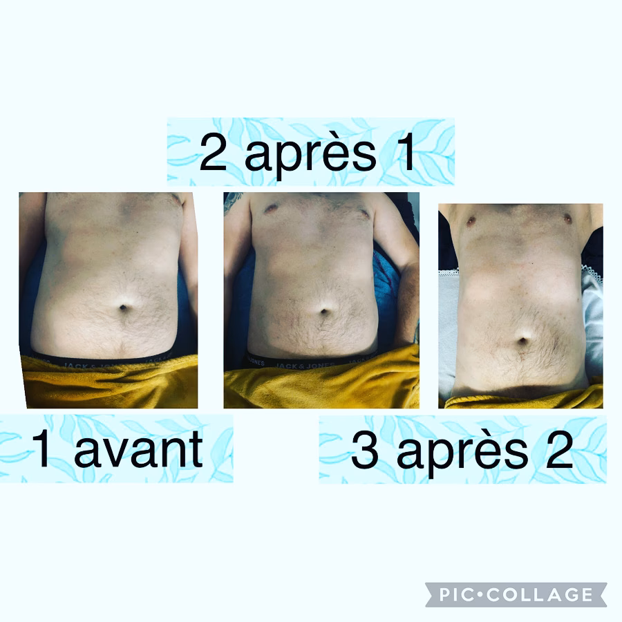 Qu'est-ce que le drainage lymphatique brésilien ?