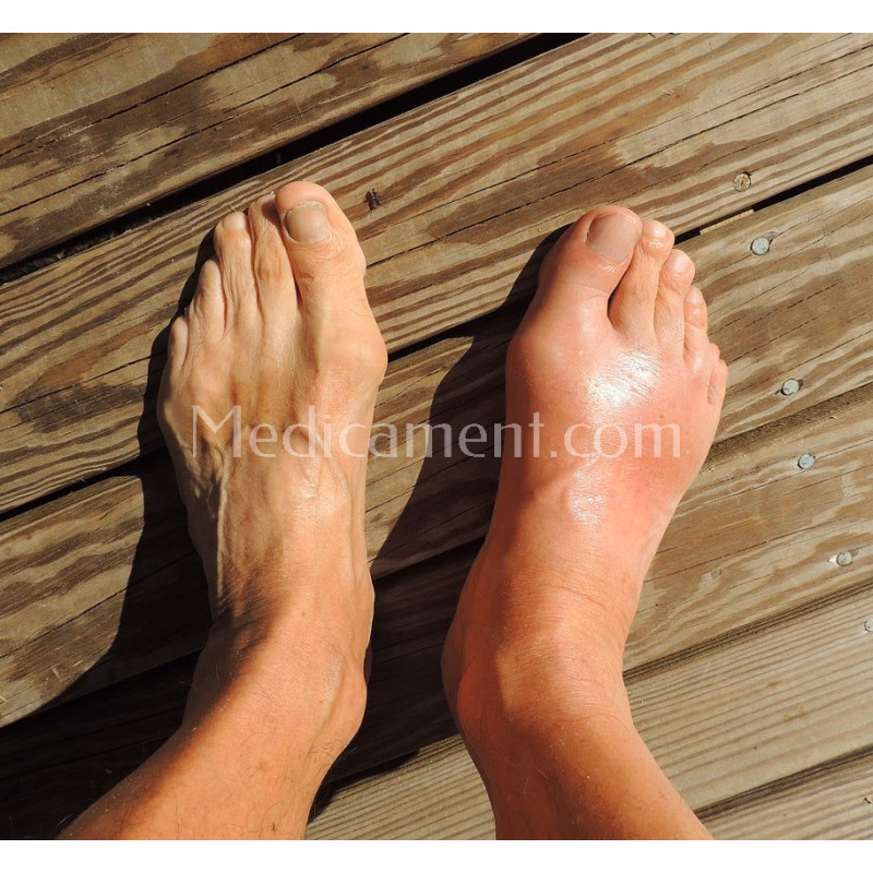 Comment soigner une crise de goutte naturellement ?