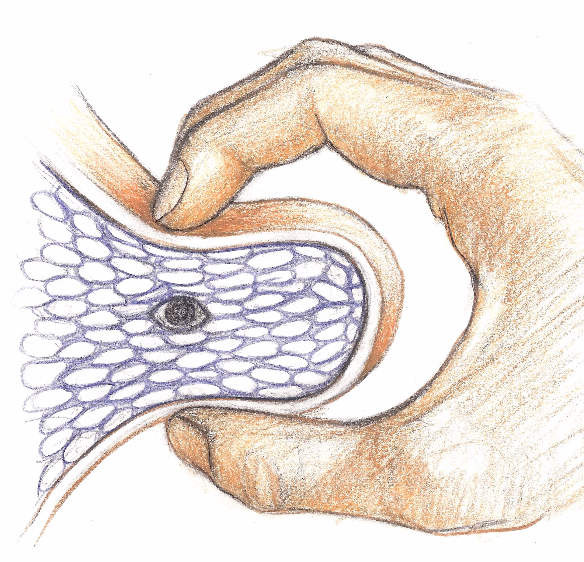 Does Thiele massage help irritative bladder symptoms?