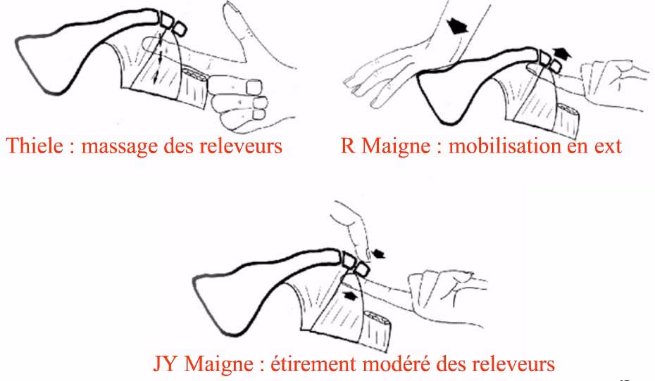 What is Thiele's massage?