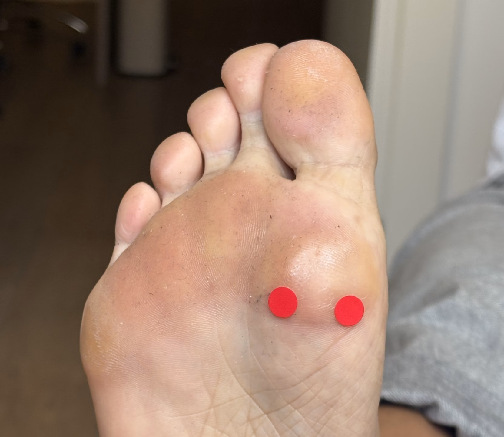 Comment soulager la douleur des os sésamoïdes?